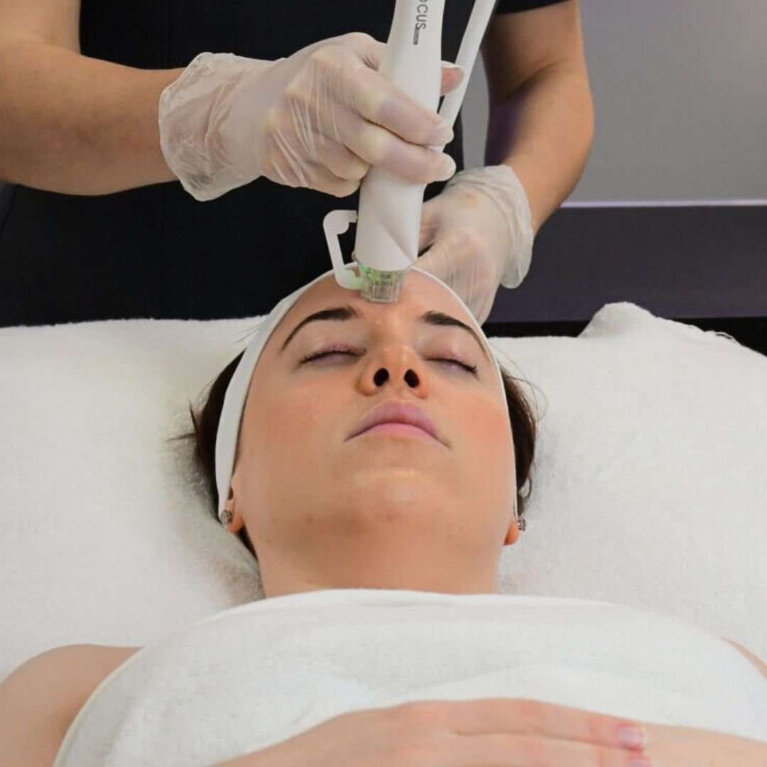 Medical grade RF microneedling treatment at our St Leonards clinic