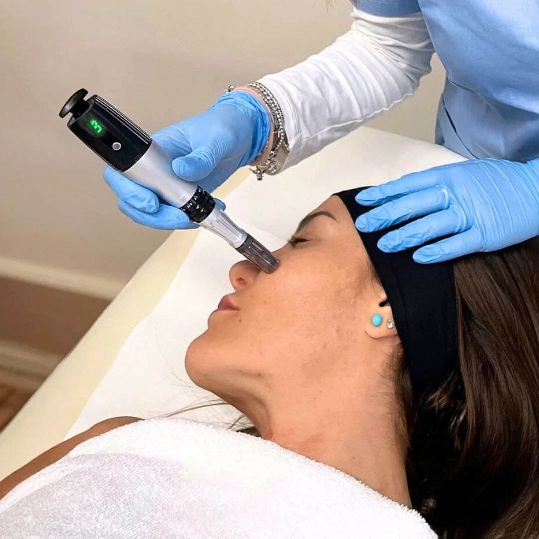 Medical grade skin needling treatment at our St Leonards clinic