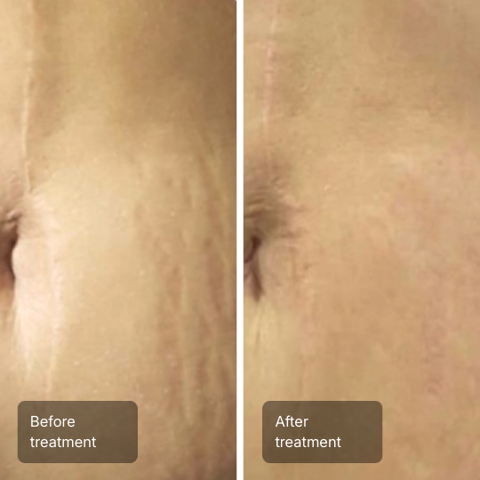 Side-by-side comparison showing lighter, faded stretch marks next to darker, newer stretch marks on skin.